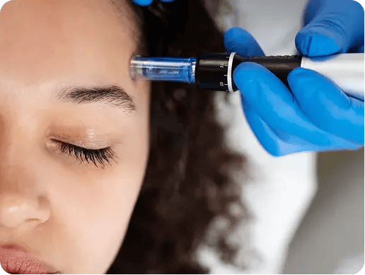 aspire-clinic-micro-needling-ideal-candidates