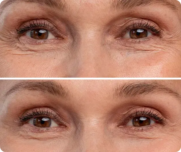 Wrinkle Injection gallery-1