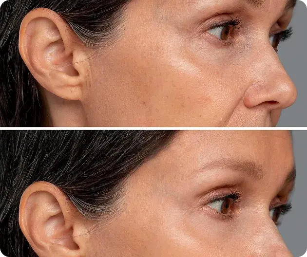 aspire-clinic-dermal-fillers-treatment-1